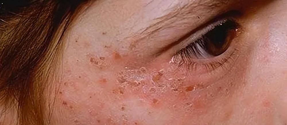 原创95后女生腹痛难忍口吐黑水就医被要求晒尿医生吸血鬼病