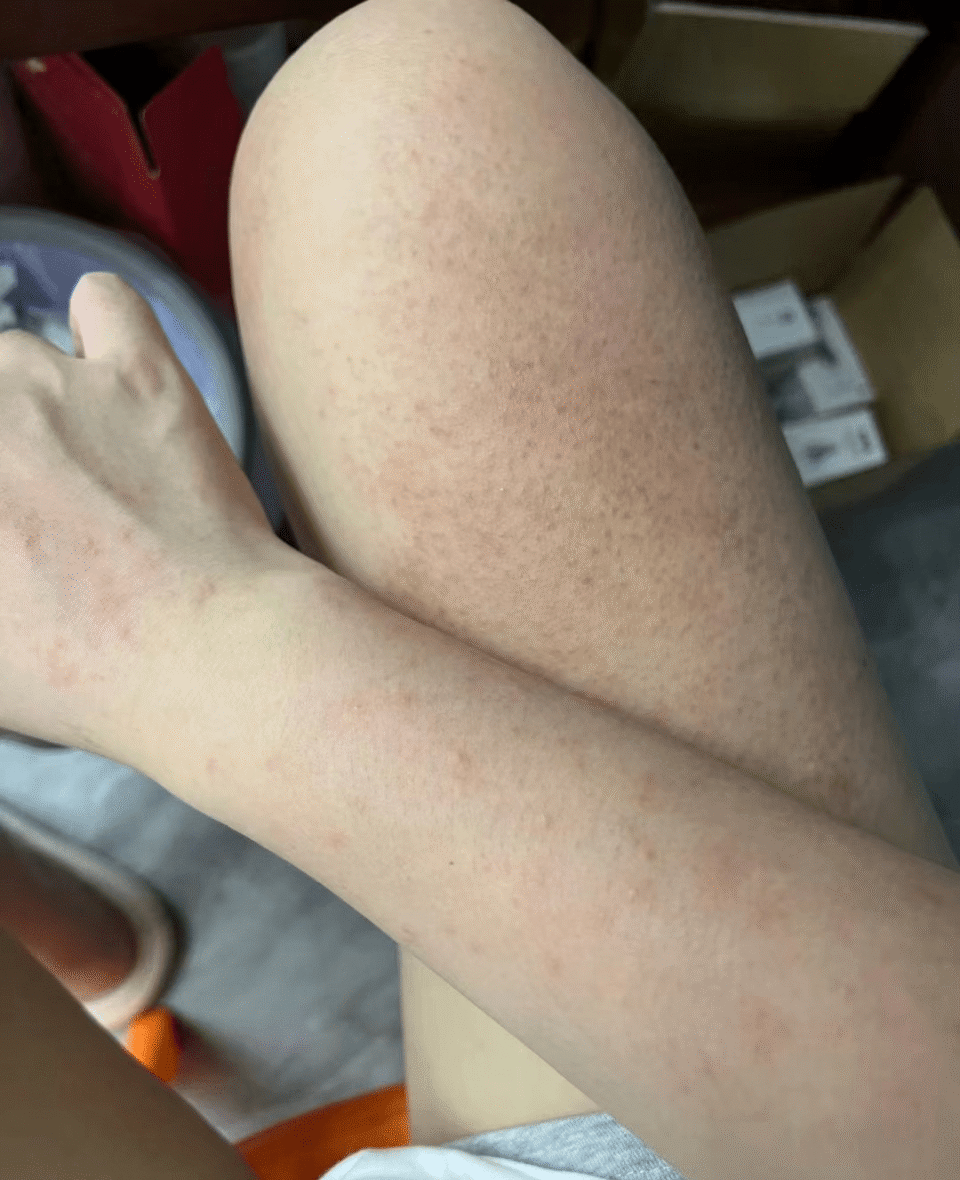 发现了一个去湿疹很牛的方法