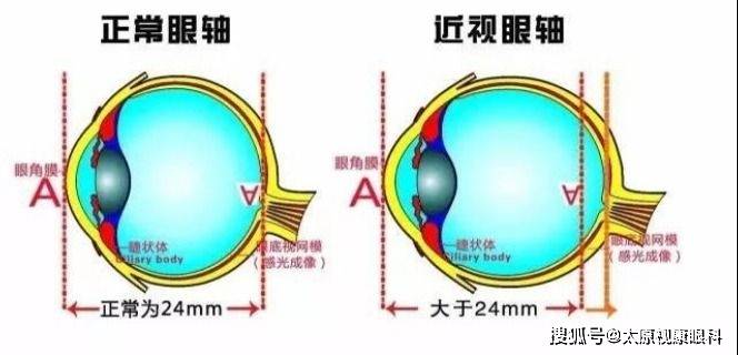 近视防控不是口号太原视康眼科提示控制眼轴增长是关键