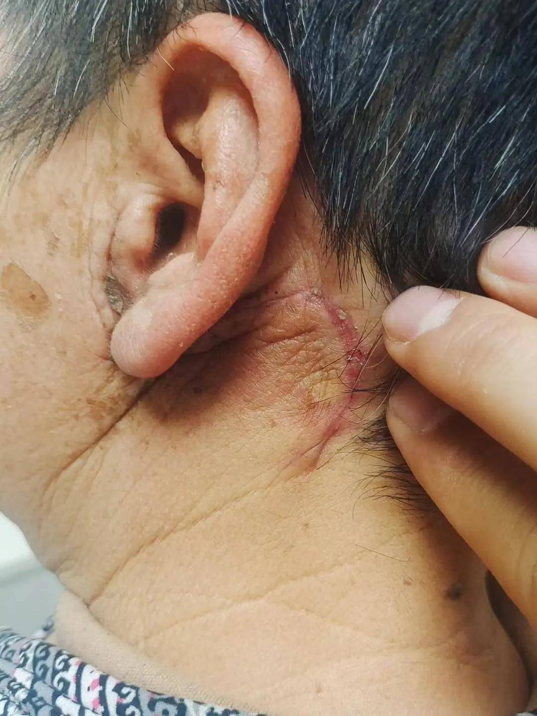 改良术式濮阳市人民医院采用改良美容切口进行腮腺肿瘤切除让瘢痕隐形
