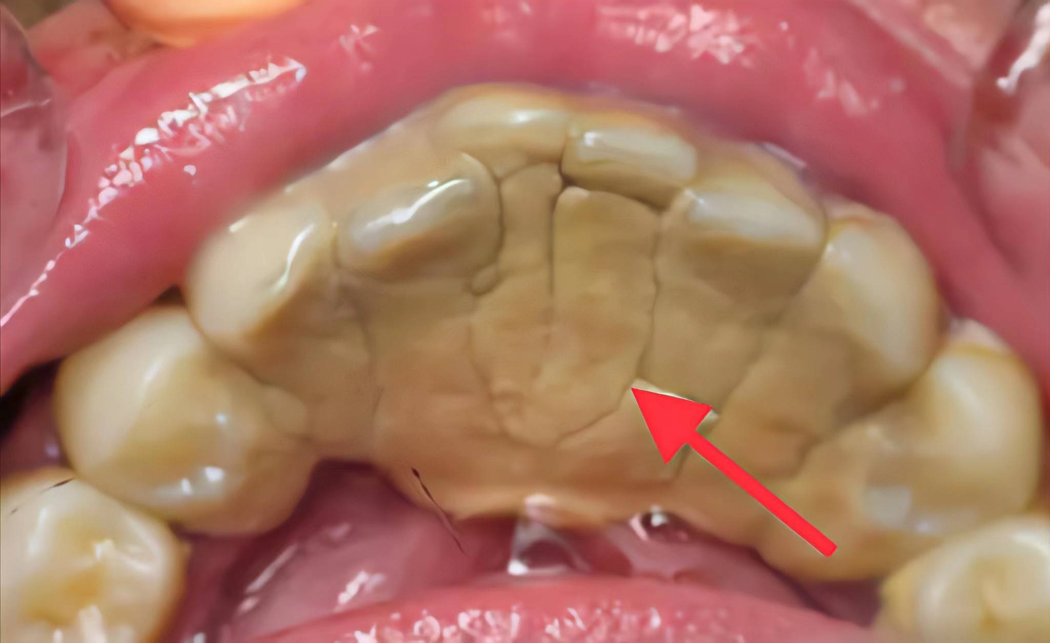 史上最强牙结石去除方法分享学会30天牙石成块掉