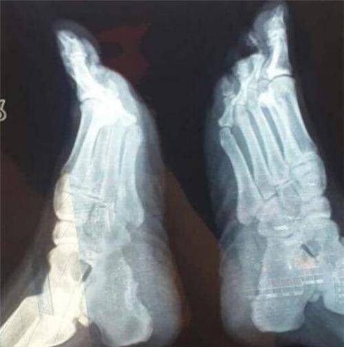 原创她花400多万整容200多次双腿彻底报废出行依靠轮椅