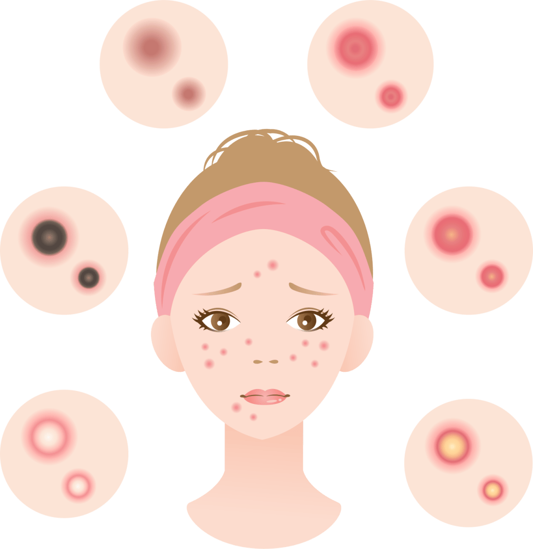 玫瑰痤疮反反复复让薇莱美为你保驾护航