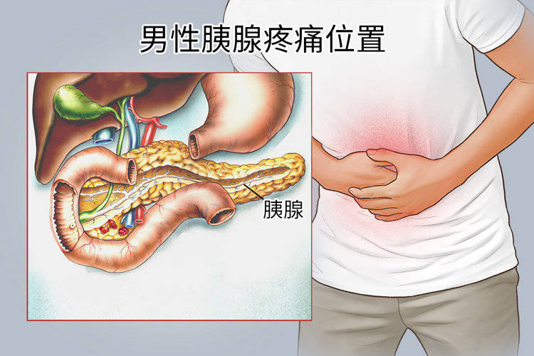 胰腺癌发生的高危因素有哪些(胰腺癌的早期症状是什么)