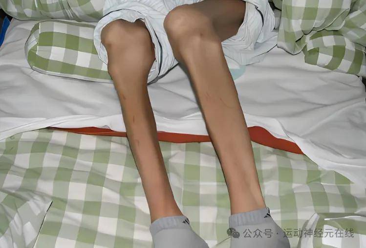 运动神经元病患者肌肉萎缩还能长起来吗