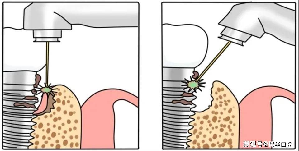 技术领航穗华口腔引进水激光技术让看牙更舒适