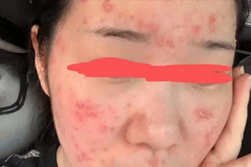 痤疮痘痘掌握这3招在家就能有效处理根本不多冤枉钱