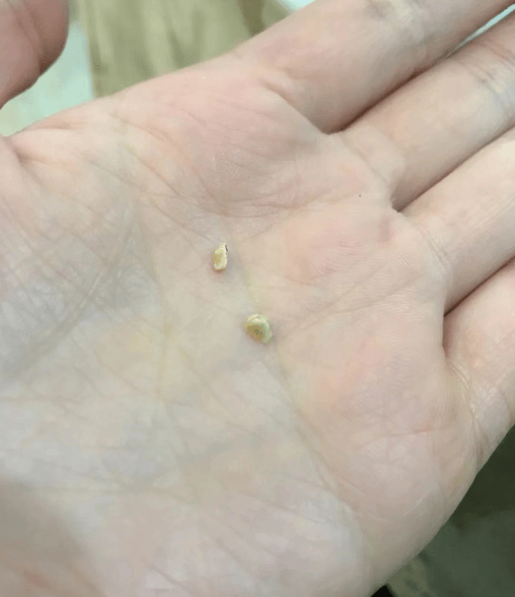 公认好用的去牙结石妙招现在曝光!短短30天牙石自己哗哗掉!