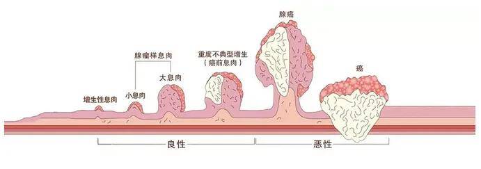 息肉图片