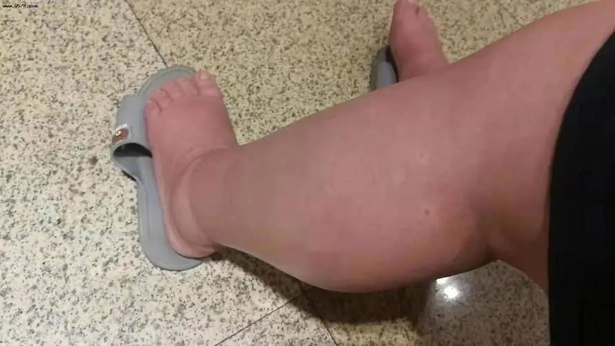 好孕36计 | 孕期毁容式水肿,这种情况你要注意_变化_检查_小腿