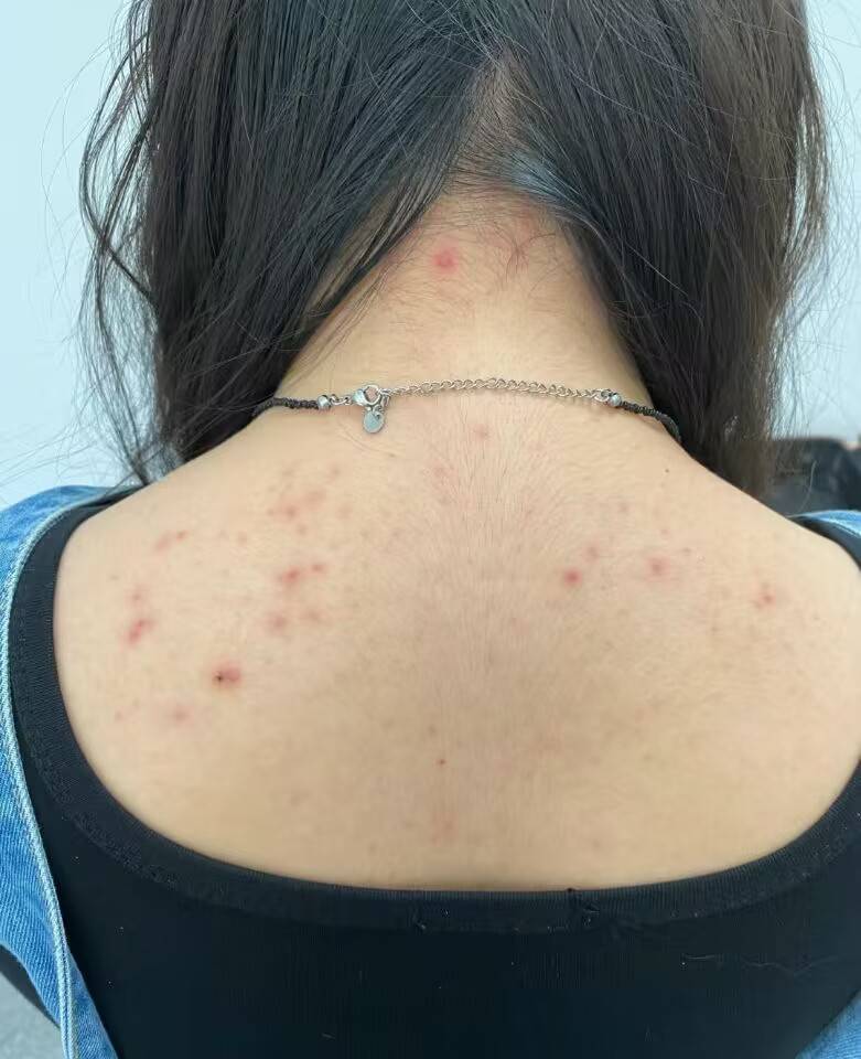 皮肤_经验_痘痘