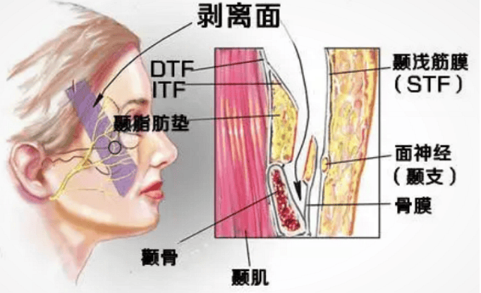 脸部拉皮能保持几年~不敢相信~ 3