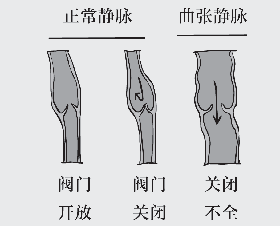 从蚯蚓腿到老烂腿静脉曲张不得不说的痛