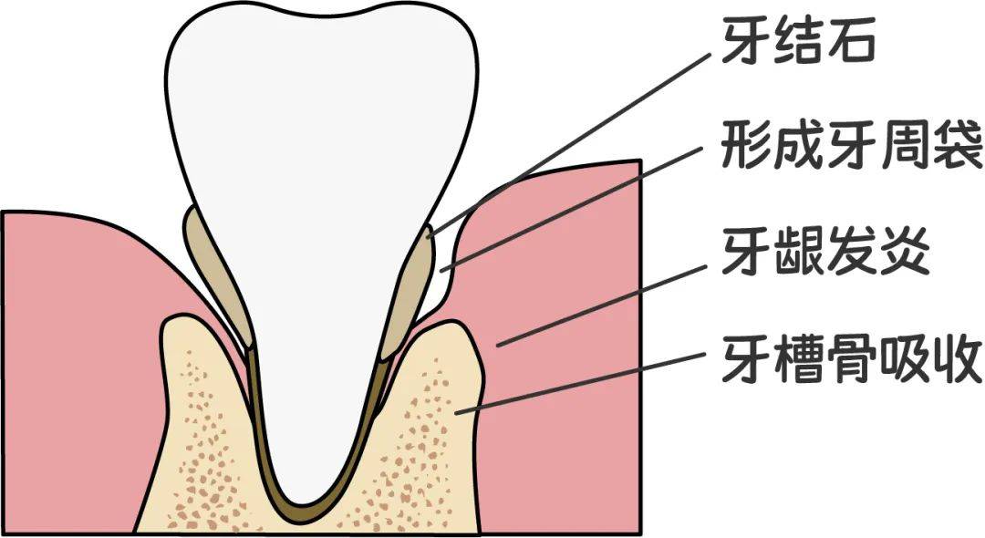 我只是洗个牙,为啥医生让我做龈下刮治?