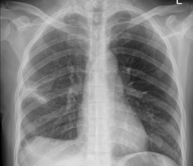 患上百万分之一的罕见病专家联手为其治好肺部布满的肥皂泡