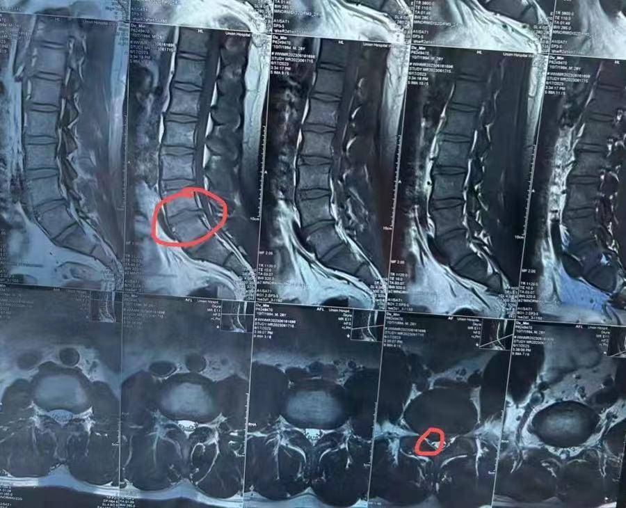 产后腰突不要怕用了这个方法保你7天消除腰疼腿麻