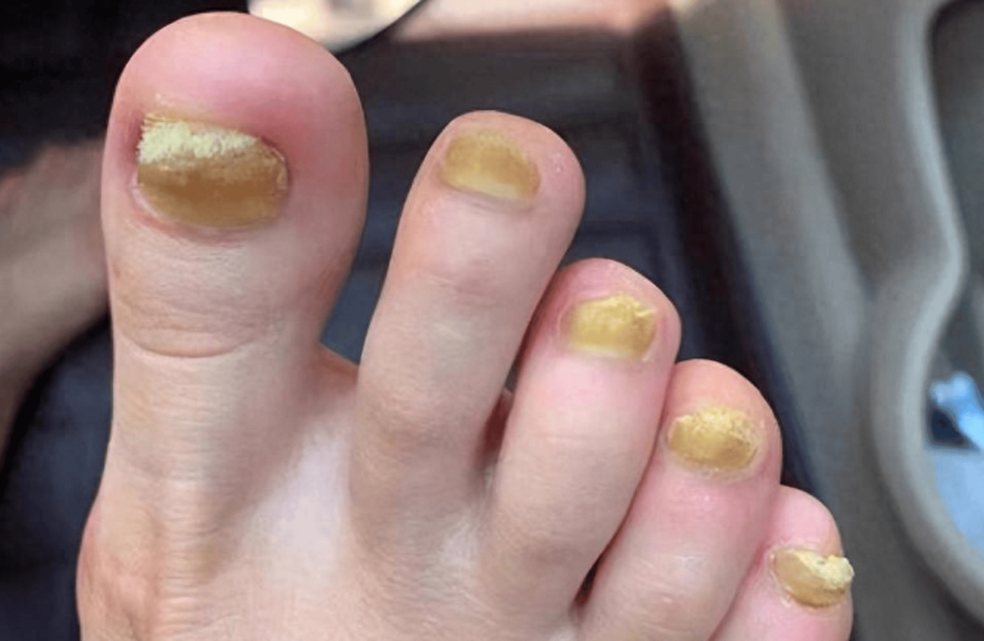 血泪教训灰指甲别再拖了3个亲测祛灰妙招赶紧用病甲变亮甲