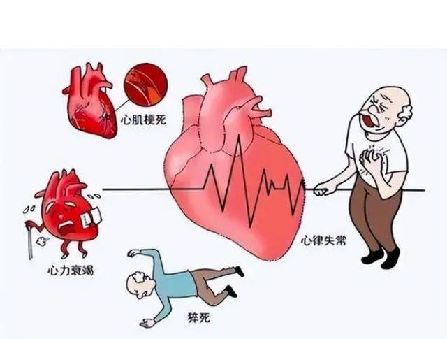 甘油三酯高到多少可能诱发心梗?医生 超过这个数