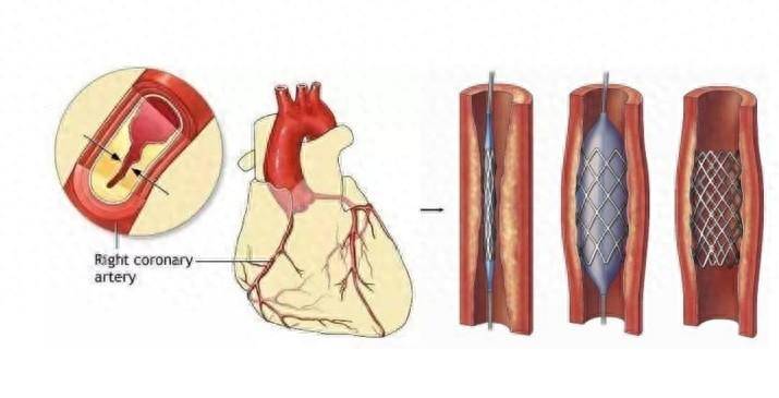 放完心脏支架就能高枕无忧了?错 你还须牢记这些事