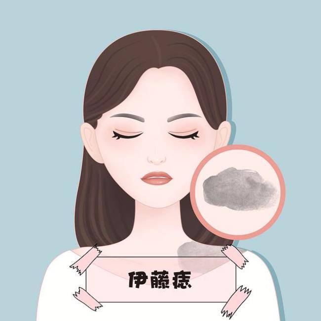 沈阳肤康为您解析:伊藤痣的科学应对与治愈之道!