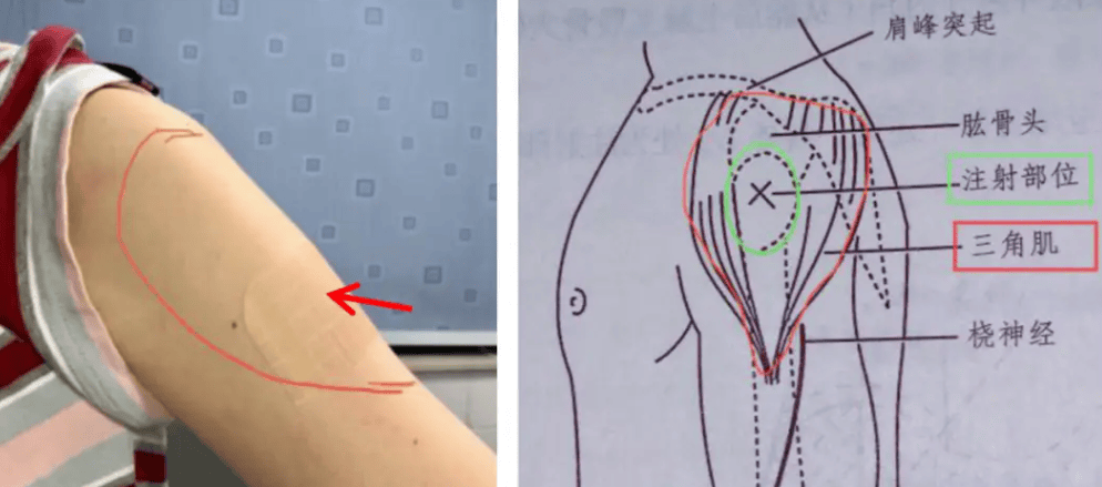 三角肌前束疼里面疼图片