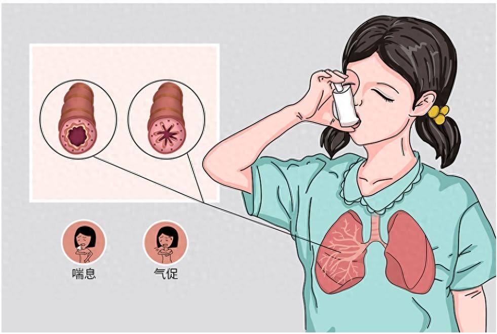 世界哮喘日:为哮喘患者健康赋能,让呼吸更自由!