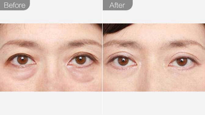 手术眼袋祛除,做眼袋手术大概需要多少钱?安全吗?告诉你真相