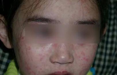 传染性极强!(不是水痘)