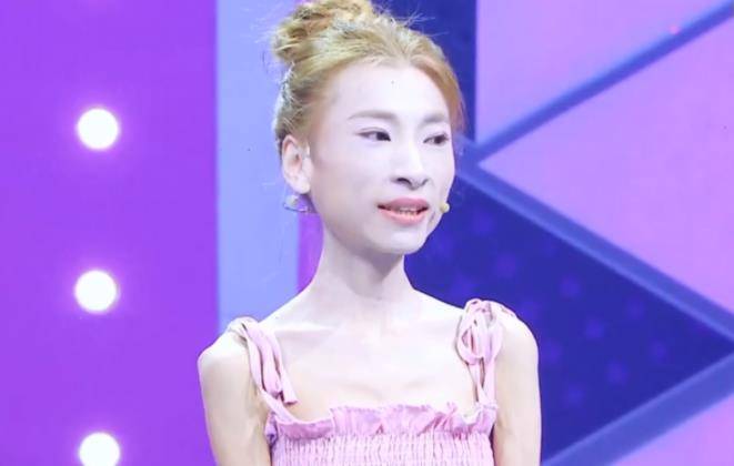 "骷髅妹"刘野:自虐式减肥,120斤减到57斤,直接吓跑网恋对象