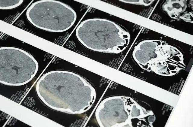 照一次ct,对人体有伤害吗?终于有医生肯站出来说实话了