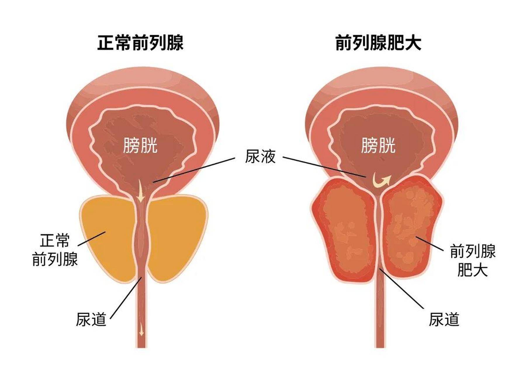 前列腺炎位置 男生图片