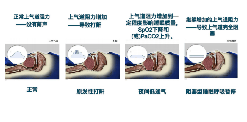 呼吸机家用品牌排行榜!家用睡眠呼吸机,谊安呼吸机好用吗?
