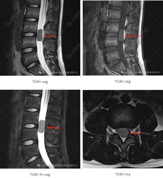 14岁男孩,腰腿痛,下肢麻木不可忽视椎管内神经鞘瘤