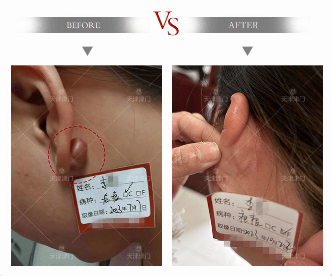 耳洞增生手术多少钱图片