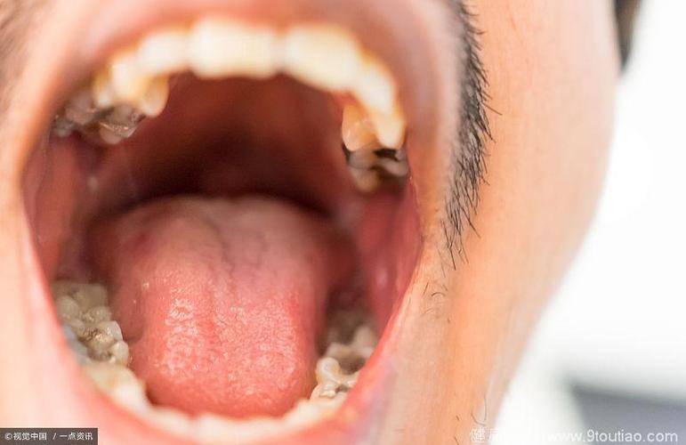 体内有癌,嘴知道?口腔出现4种现象,或许是癌细胞在活跃