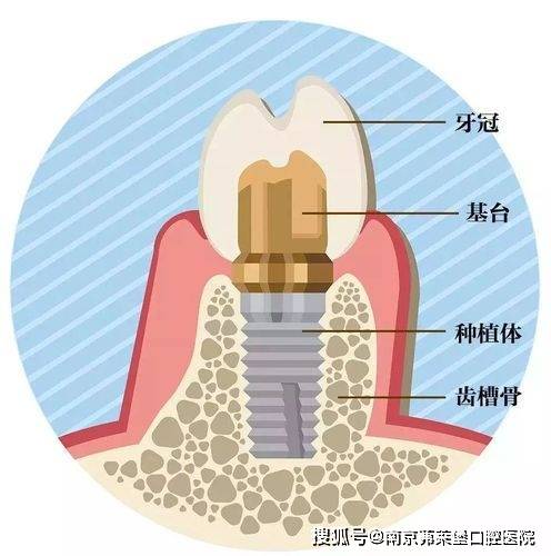 南京牙齿种牙医院:种个牙齿要多少钱一个