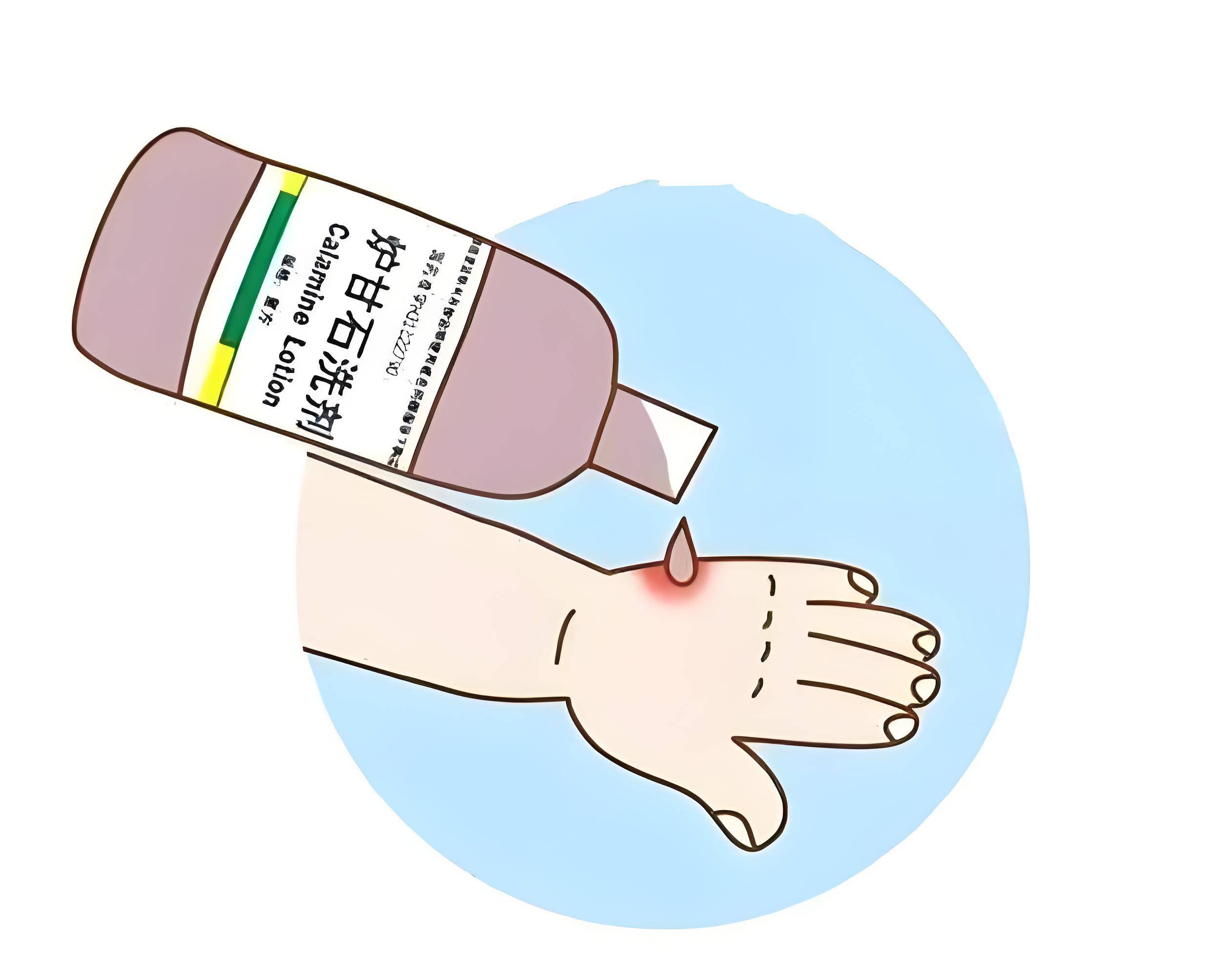 一到夏天就长磨人的"小水泡"?今天就告诉你怎么治