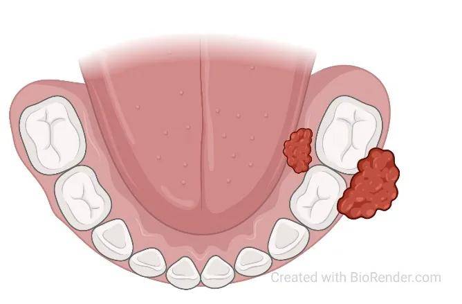 以为是口腔溃疡,医生却告诉我是牙龈癌?