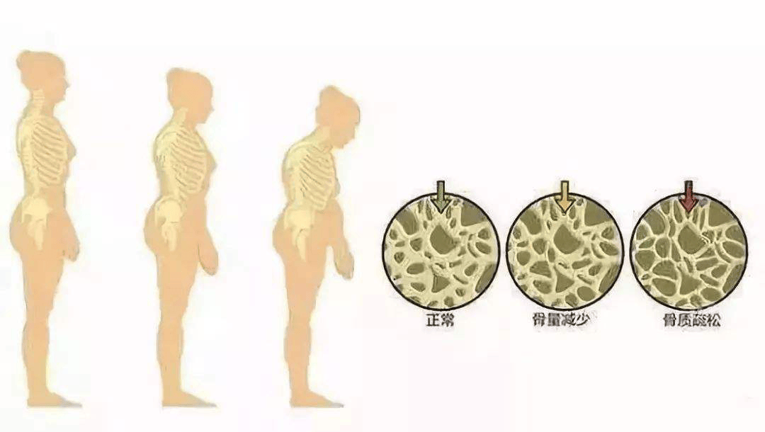 胆结石背痛位置图图片