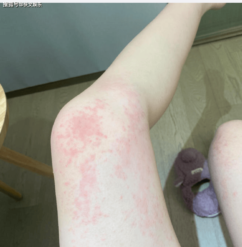 赵露思现身上海就医!皮肤状态发红起疹,怕风怕花粉怕刺激引热议