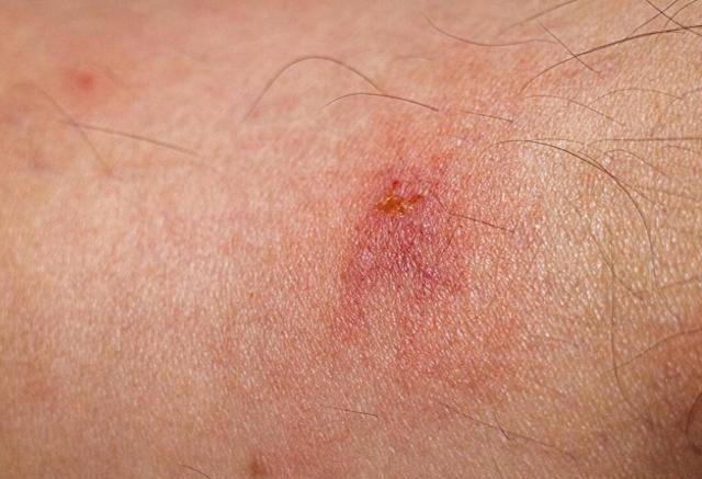 如果你发现皮肤上的痣,疣或其他斑点出现异常发痒,并且有不断增大的