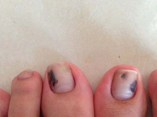 灰指甲的病因还有这些,一般人都忽视了这些小细节!_真菌_甲癣_原因