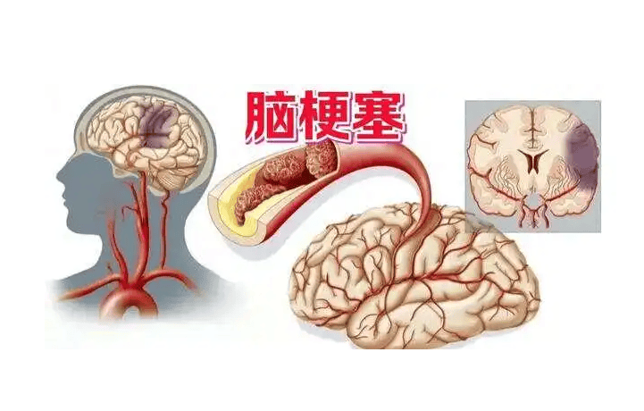 生命海洋治疗仪│睡觉时若有4个异常,警惕脑梗!