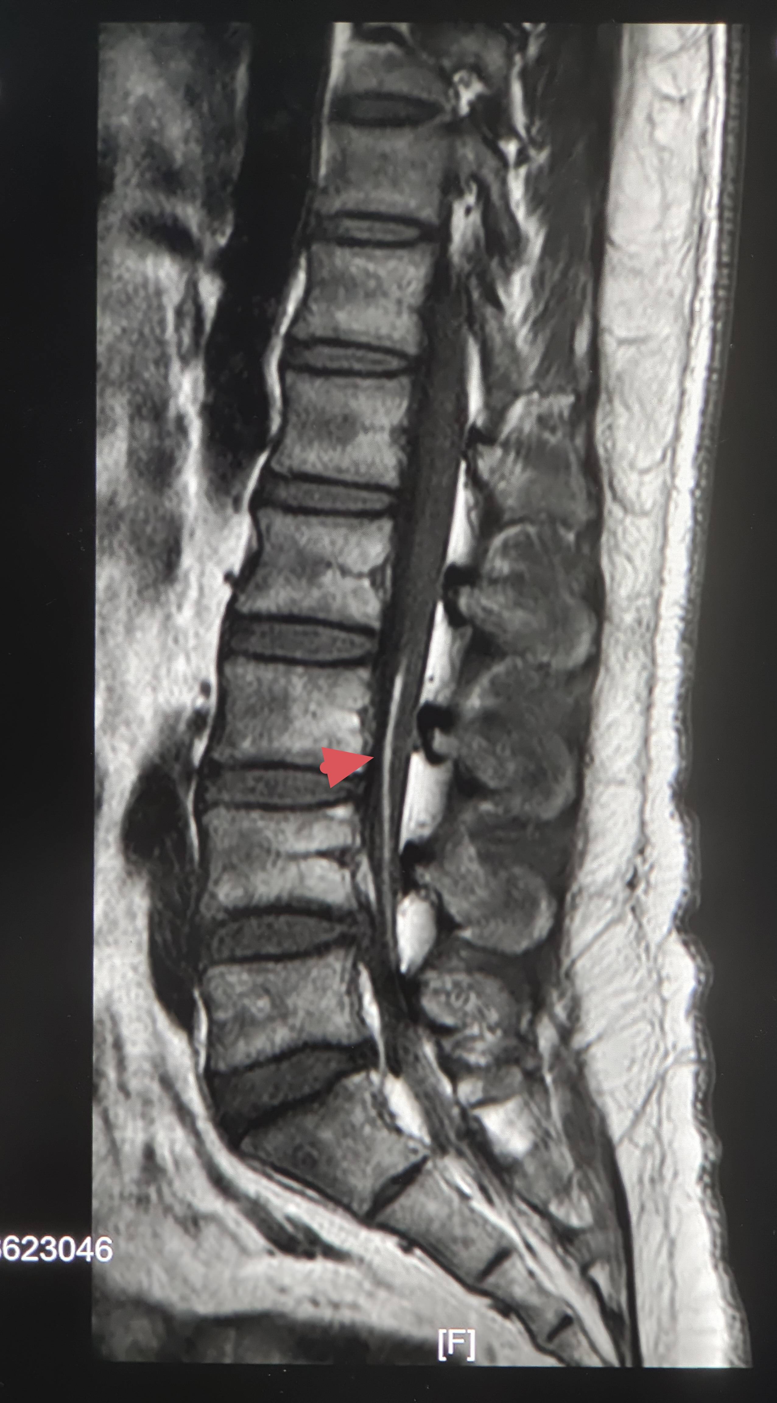 终丝脂肪沉积_脊髓_症状_临床