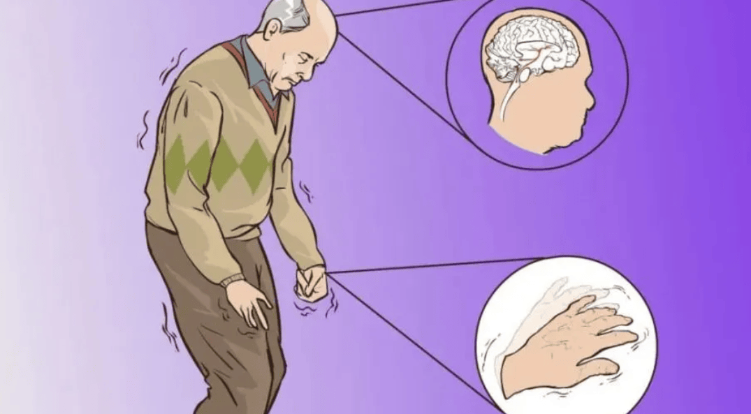 帕金森性痴呆的症状以及如何预防