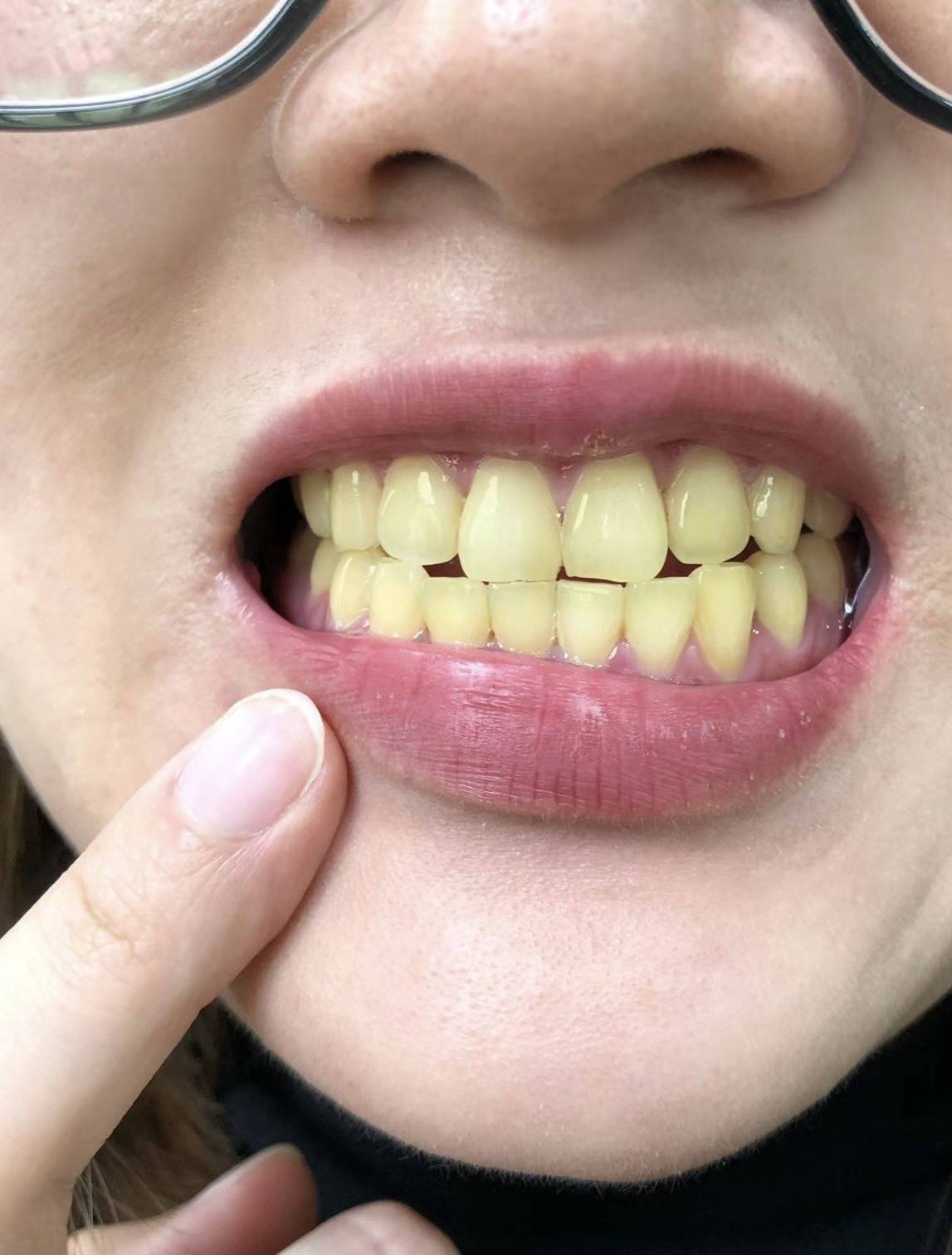 但是没想到这竟造成我牙齿变的越来越黄,真的是一张口一