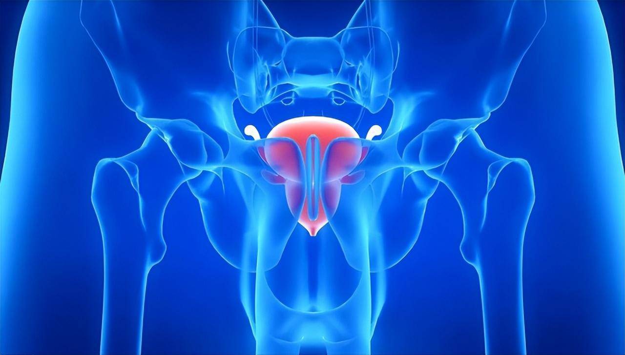 小心前列腺结石!做好6个早期筛查