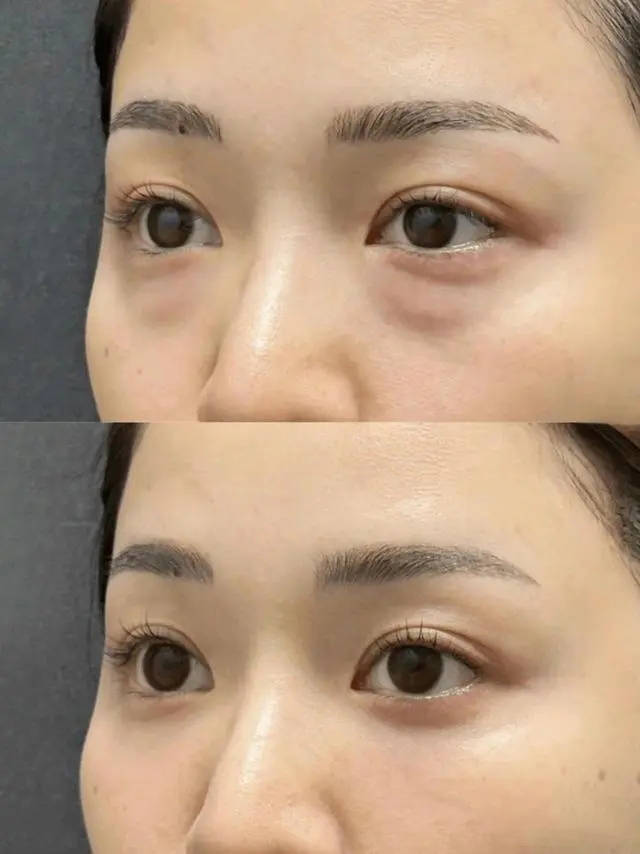 质地方面挺适合夏天使用的,眼霜上眼很好推开不油腻,轻轻按摩几下就