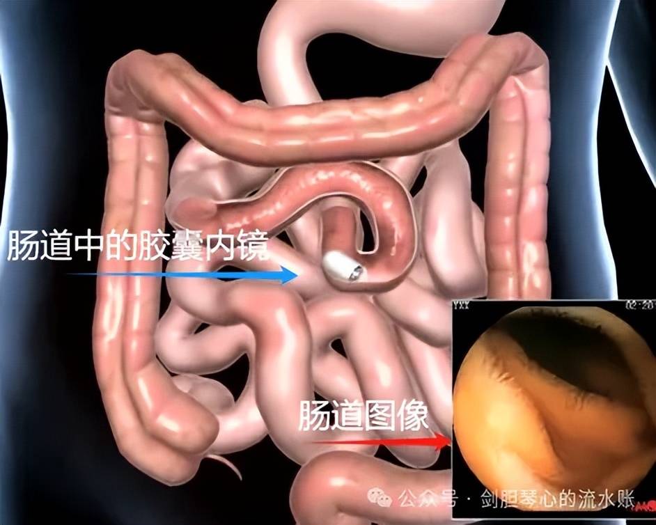 肠镜6张图片对应部位图片