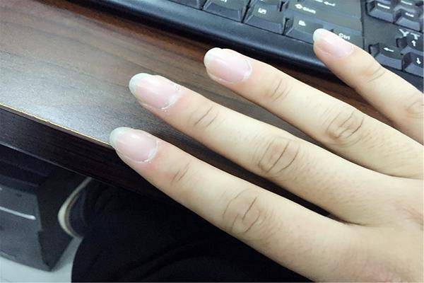 指甲上出现凹陷,竖条纹,暗示什么问题?不妨自查下,别掉以轻心